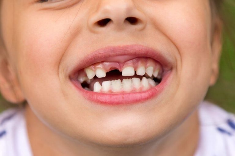 What to Do If Your Child Knocks Out a Tooth