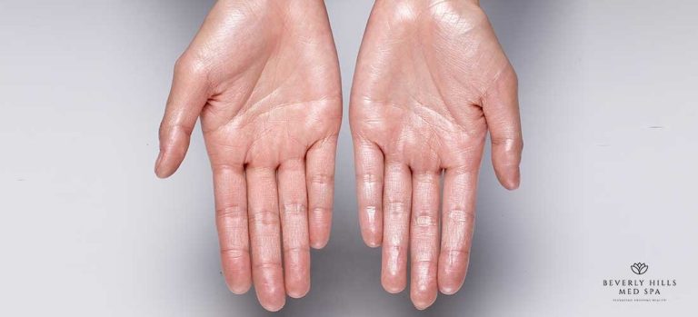 Sweaty Palms: Treatment and Home Remedies That Actually Work