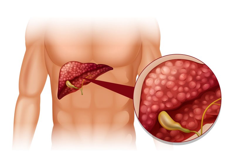 Gallstones Removal Singapore: What Your Options Look Like