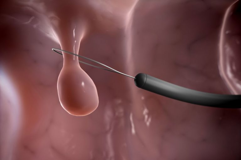 Understanding the Risks and Benefits of Polyps Removal Singapore