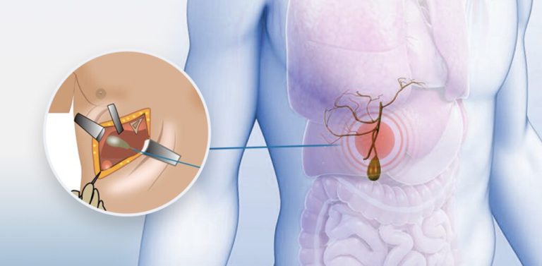 Risks and Complications of Gallstones Removal Singapore