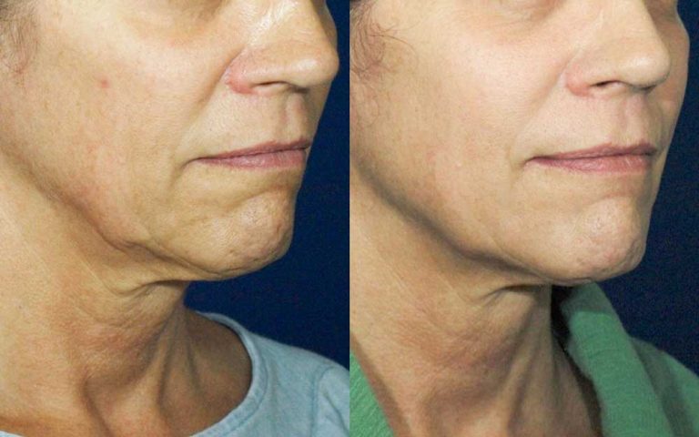 Ultherapy Treatment Singapore for Loose or Drooping Skin on the Lower Face