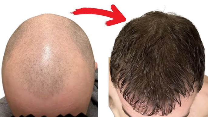Hair Transplant Singapore for Age-Related Hair Loss: What to Expect After 40